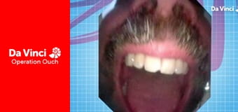 Operation Ouch! - Do Try This at Home - Fingerprints