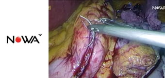 Sala operacyjna S1E2 - Moja walka z otyłością