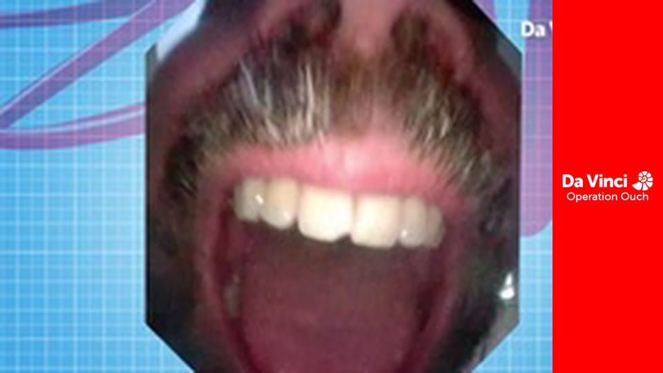 Operation Ouch! - Do Try This at Home - Fingerprints