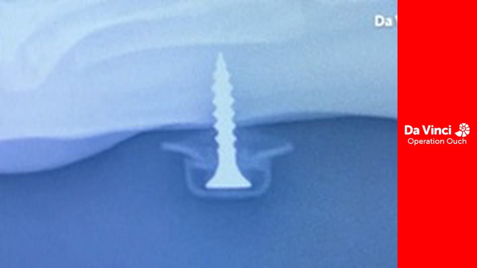 Operațiunea Au! - Gură contra genunchi