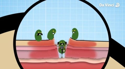 Operation Ouch (2012) - 2 sezóny 9. odtlačok prsta pľúc